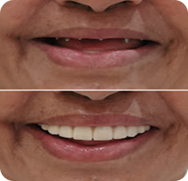 full mouth dental implants